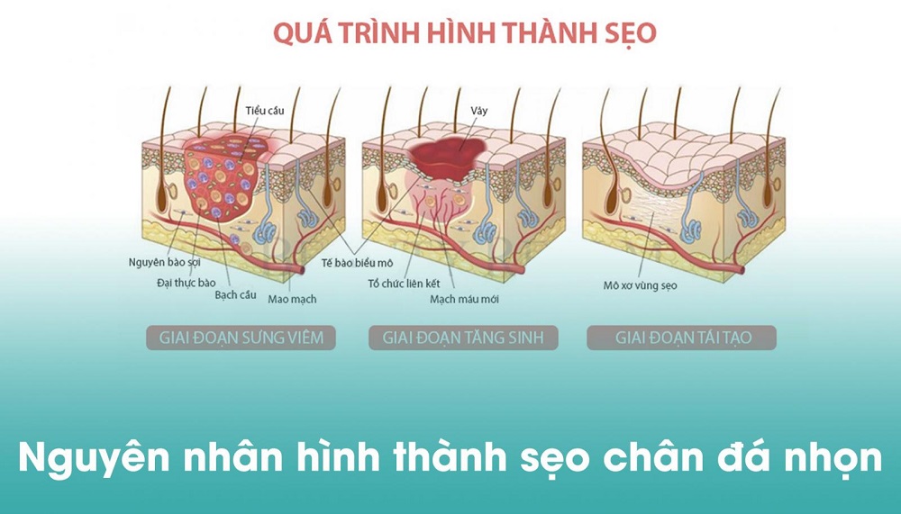 Sẹo đáy nhọn là gì? Top 5 cách điều trị sẹo đáy nhọn hiệu quả hiện nay- Ảnh 2.