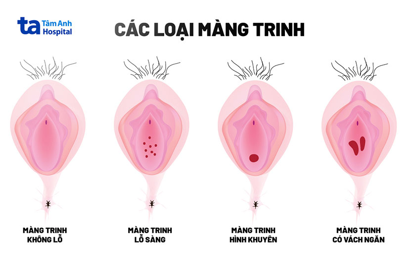 các hình dạng của màng trinh