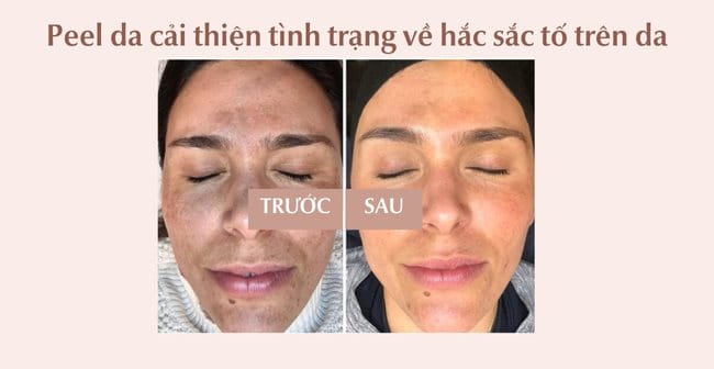 Peel da có tác dụng giải quyết các tình trạng về hắc sắc tố trên da