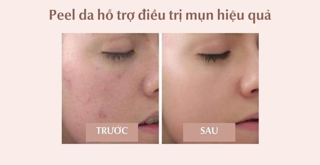 Peel da có tác dụng hỗ trợ trị mụn hiệu quả